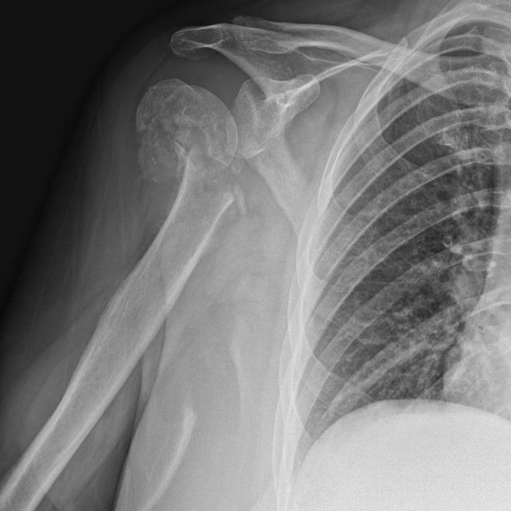 Reverse Total Shoulder Replacement | Dr Sunil Reddy